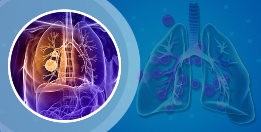 Lung Malignancy, Pleural Malignancy
